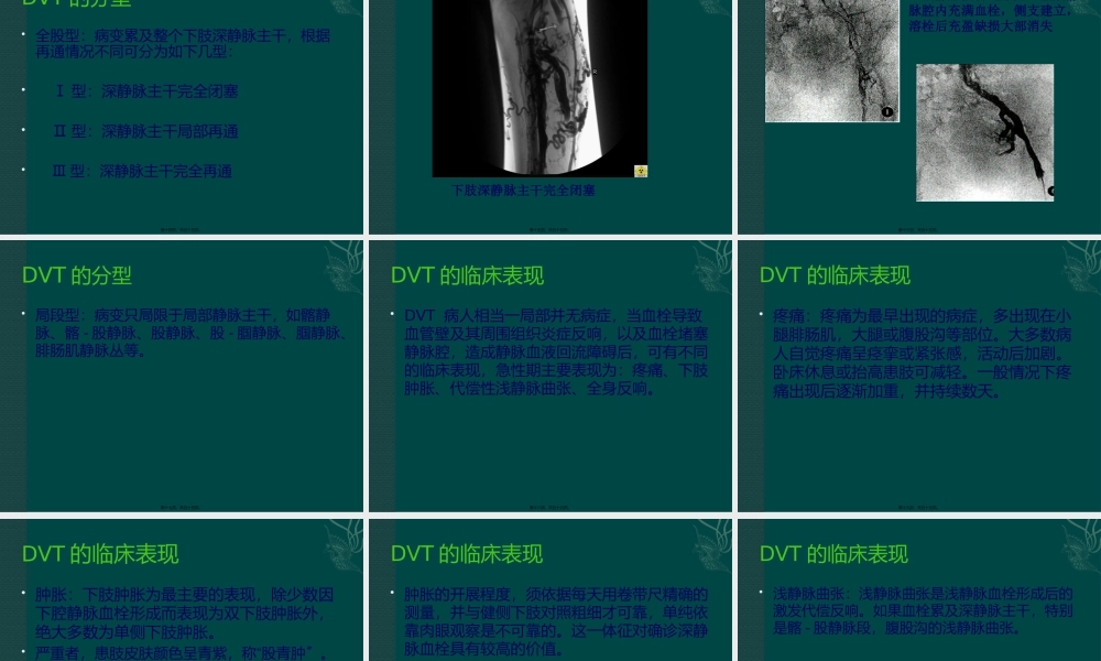 下肢深静脉血栓形成的诊治--刘凯.pptx