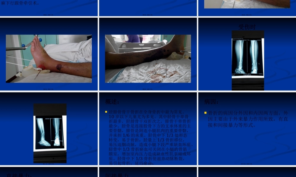 业务查房-(胫腓骨骨折).pptx