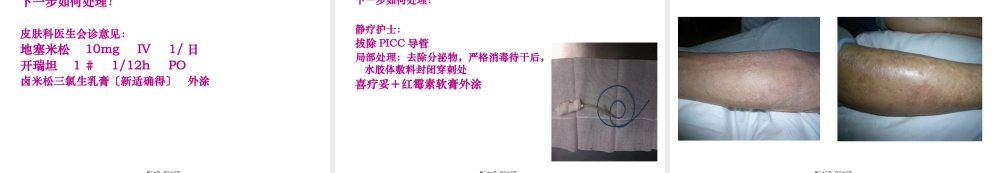 严重的接触性皮炎的处理..精讲.pptx