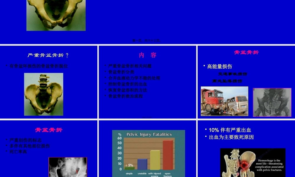 严重骨盆骨折的急救处理.pptx