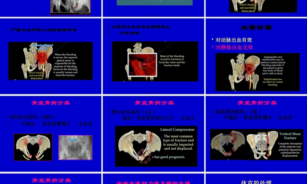 严重骨盆骨折的急救处理.pptx