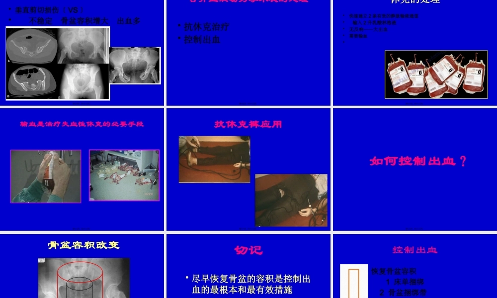 严重骨盆骨折的急救处理.pptx