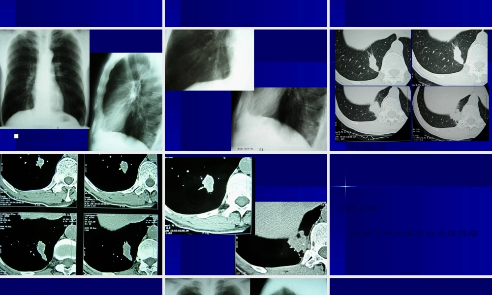 中山病例讨论7.pptx