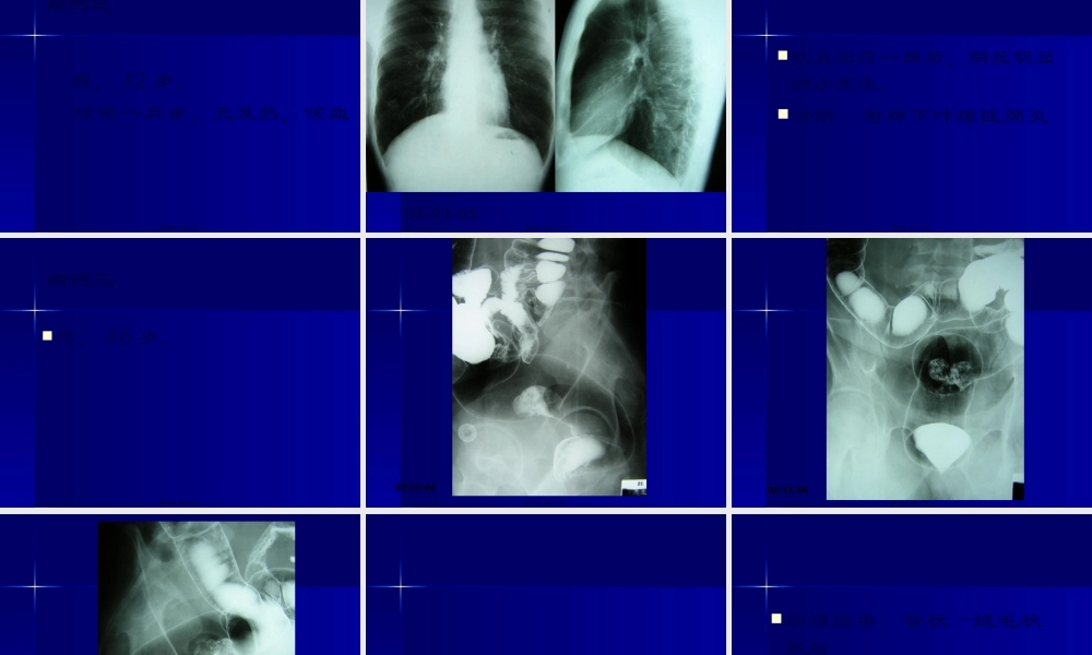 中山病例讨论7.pptx