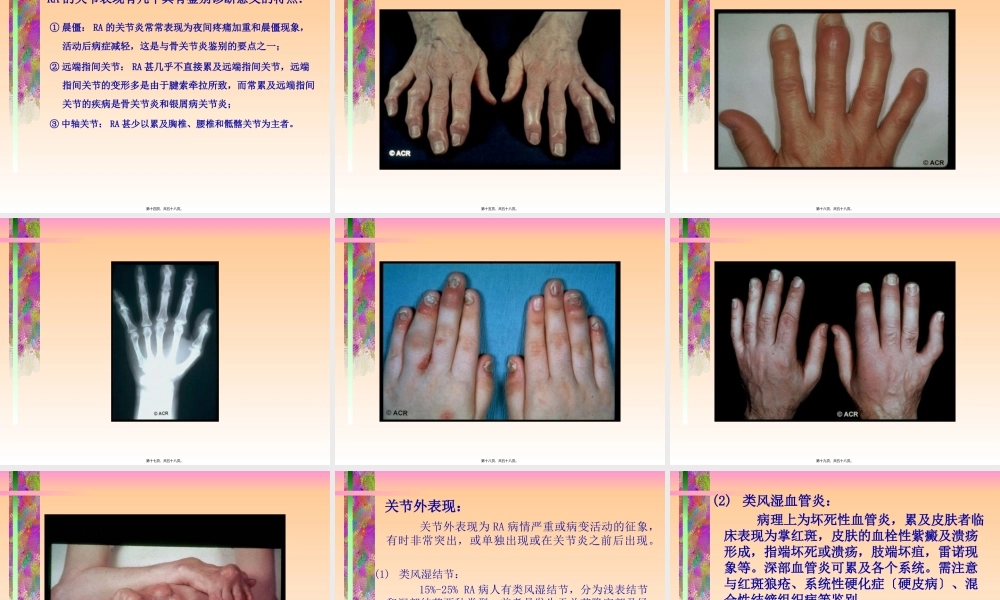 中山医科大学类风湿关节炎.pptx