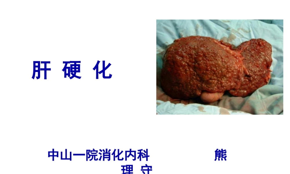 中山肝硬化概述.pptx
