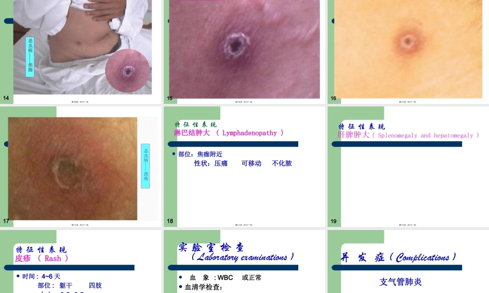 中山大学恙虫病分析.pptx