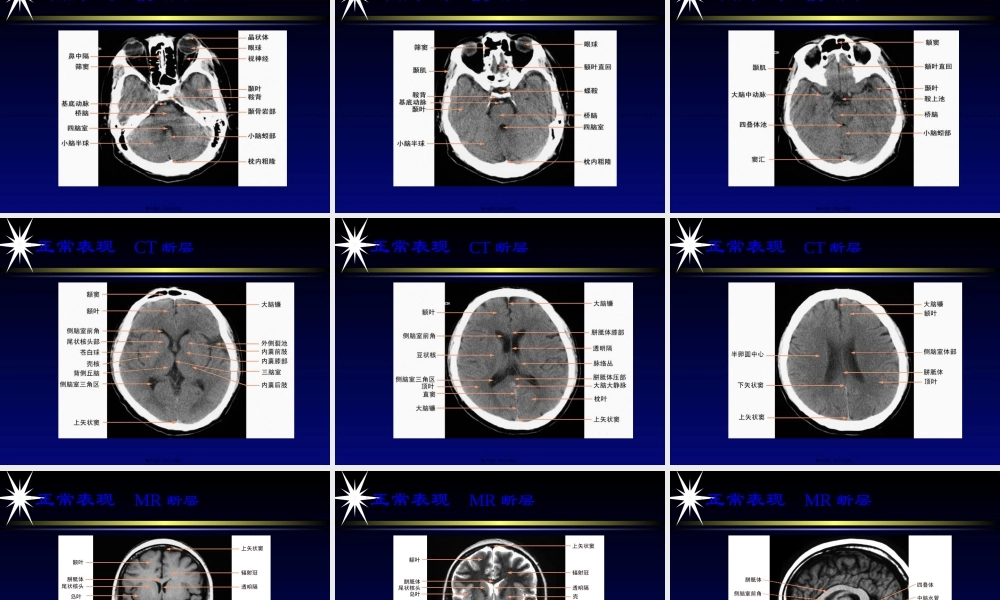 中枢神经系统影像学第一部分-2精讲.pptx