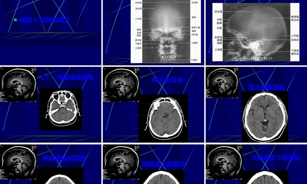中枢神经系统正常及异常影像改变(北京协和医院).pptx