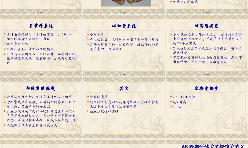 中西医结合骨伤-强直性脊柱炎.pptx