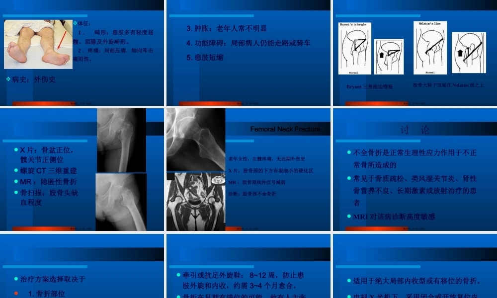 下-肢-骨-折.pptx