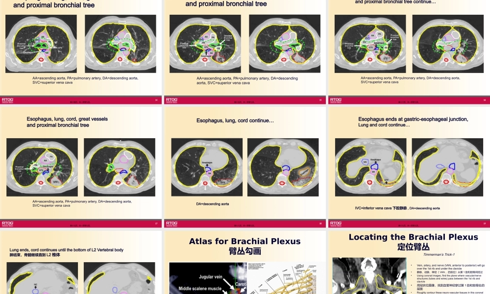 RTOG-放疗中胸部危及器官勾画-Organs-at-Risk-(OARs)-in-Thoracic.pptx