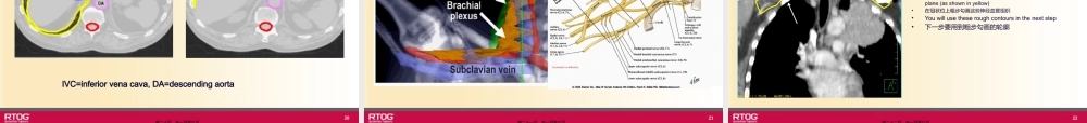 RTOG-放疗中胸部危及器官勾画-Organs-at-Risk-(OARs)-in-Thoracic.pptx