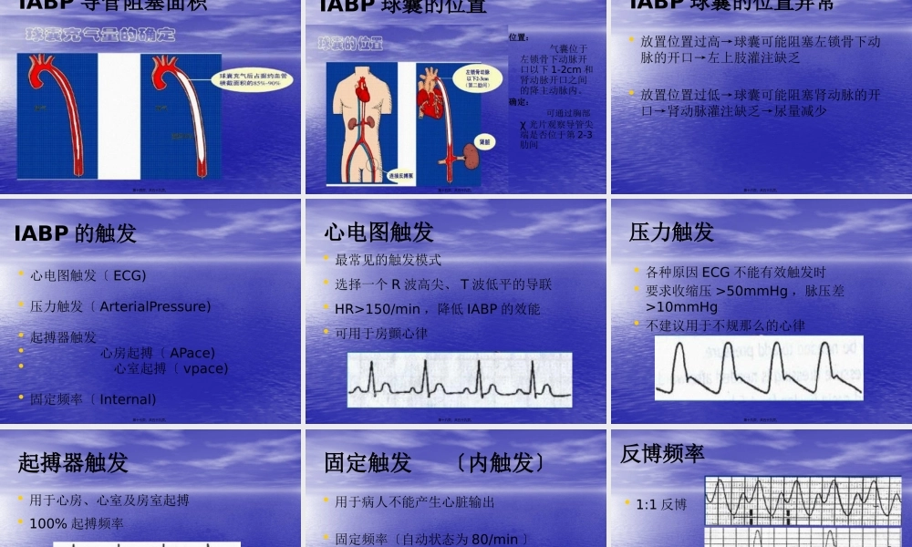 主动脉内球囊反博概述.pptx