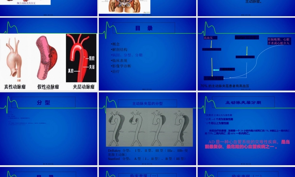 主动脉夹层(修改版).pptx