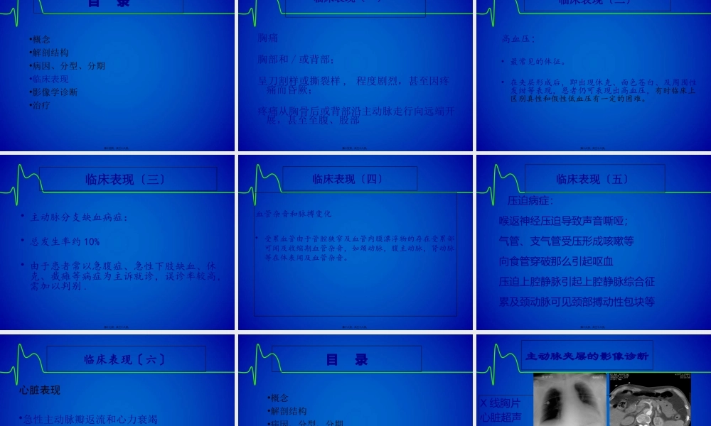 主动脉夹层(修改版).pptx