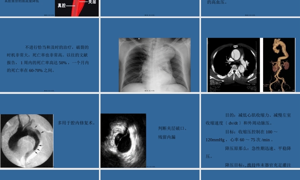 主动脉夹层与高血压.pptx