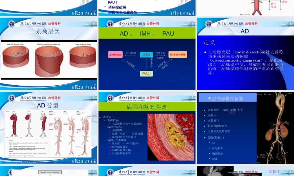 主动脉壁间血肿与穿透性溃疡.pptx