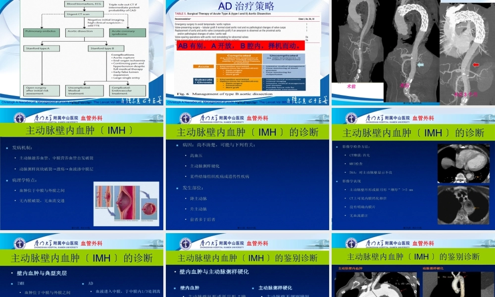 主动脉壁间血肿与穿透性溃疡.pptx