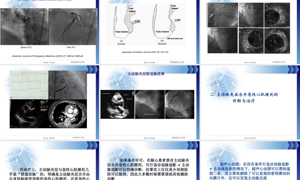主动脉夹层并急性心肌梗死.pptx