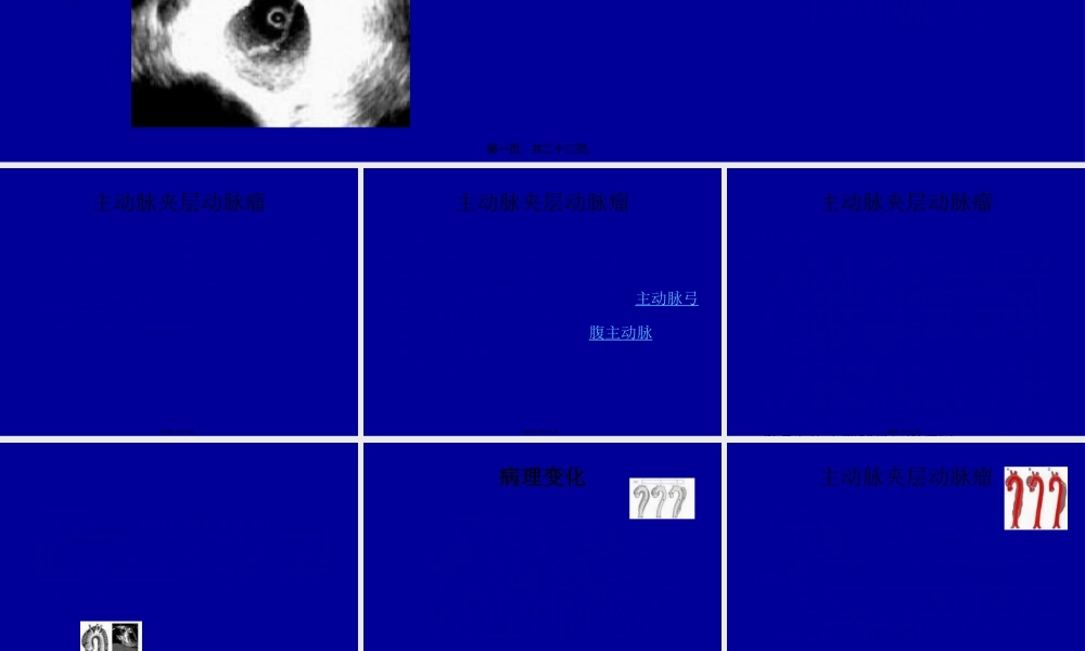 主动脉夹层动脉瘤刘崇新.pptx