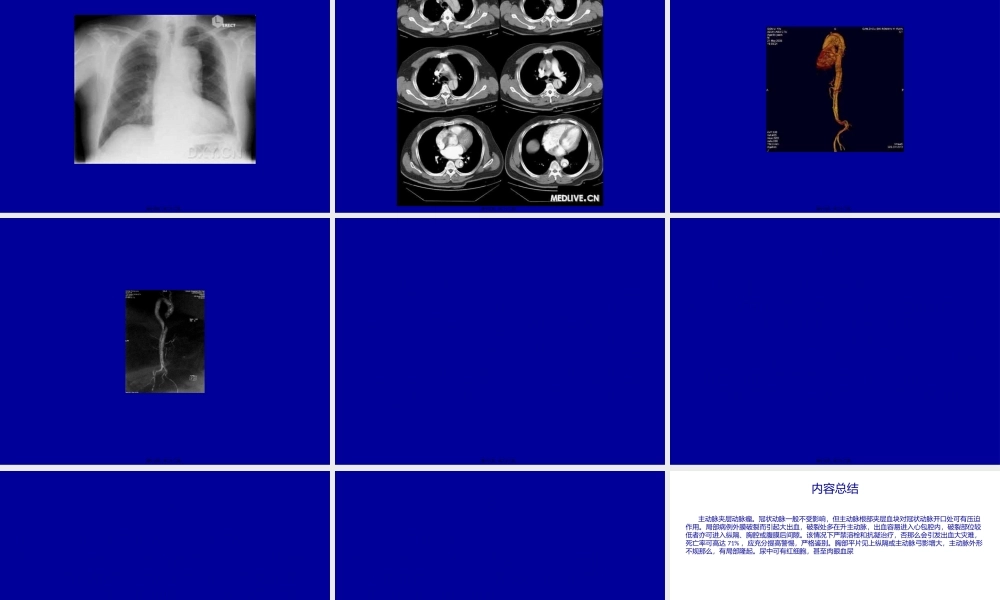 主动脉夹层动脉瘤刘崇新.pptx
