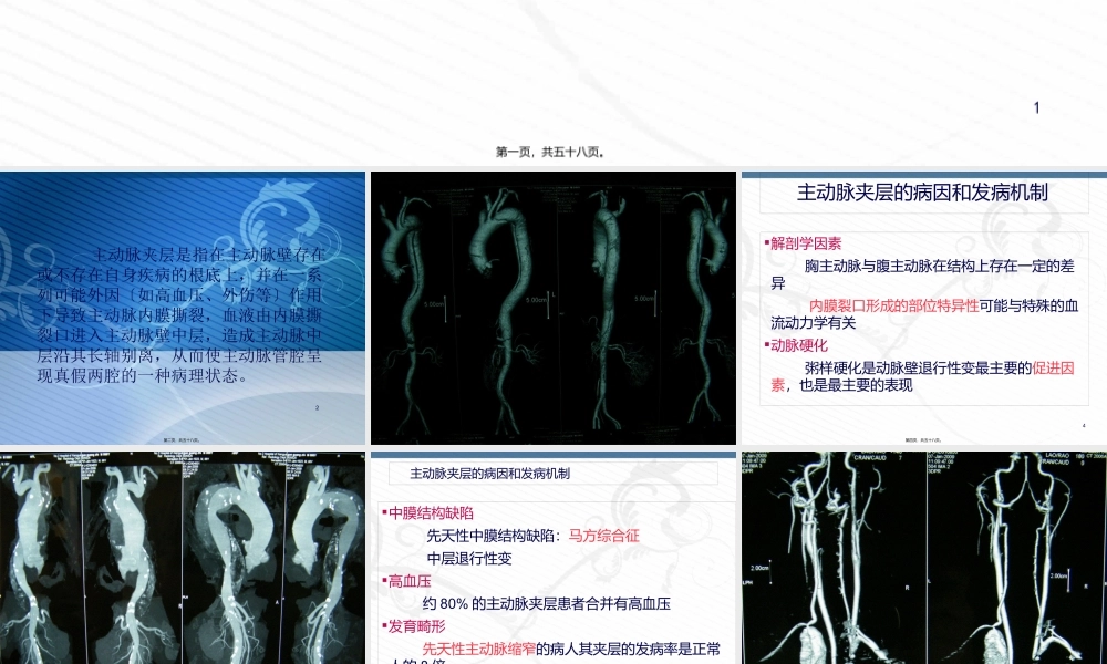 主动脉夹层的诊治进展2014.07.08.pptx