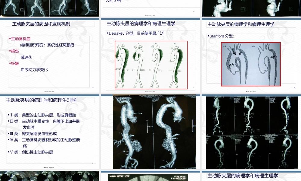主动脉夹层的诊治进展2014.07.08.pptx