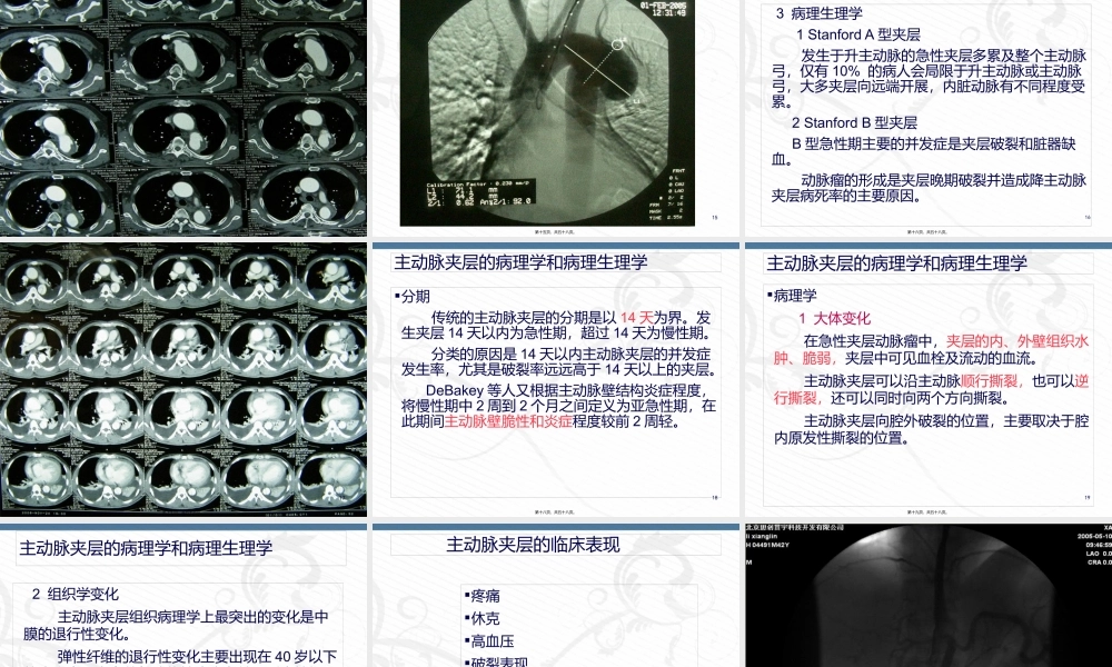 主动脉夹层的诊治进展2014.07.08.pptx
