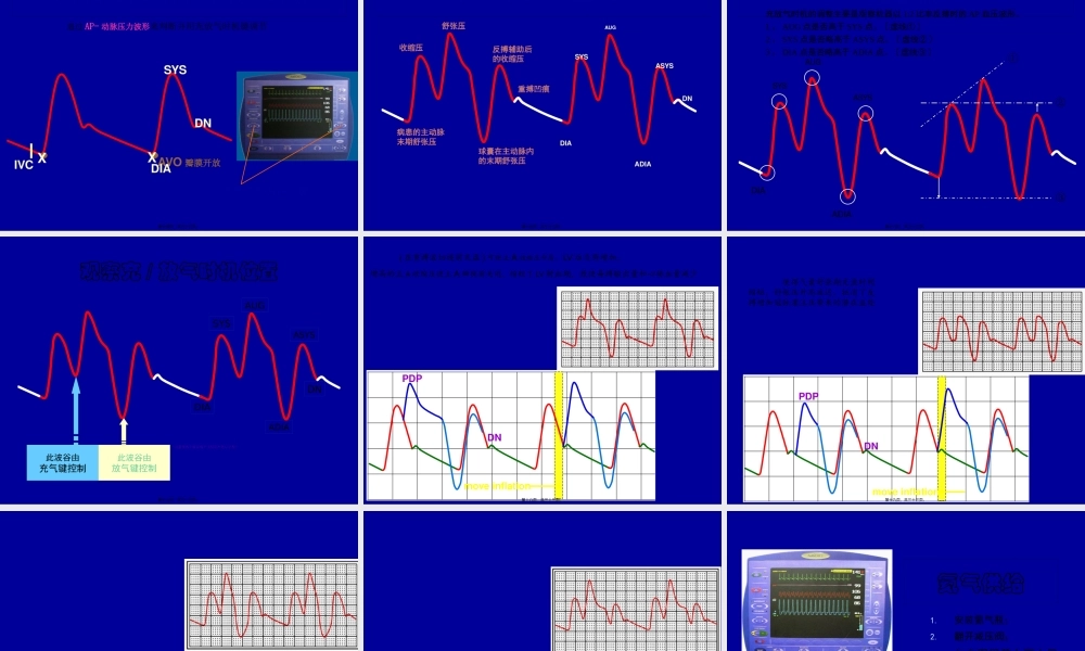 主动脉气囊反搏.pptx