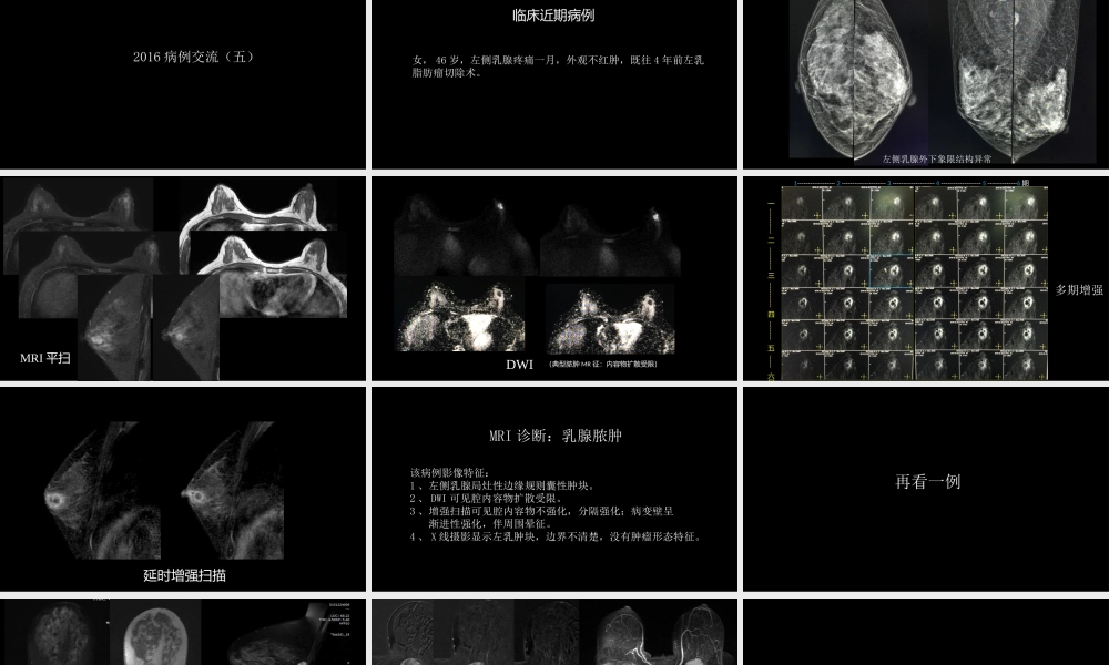 乳腺囊性肿块MRI：鉴别不困难(1).pptx