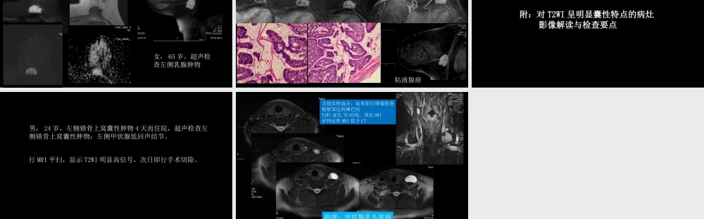 乳腺粘液腺癌MR与病理特点(1).pptx
