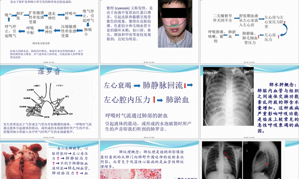 二尖瓣狭窄伴关闭不全导致的症状.pptx