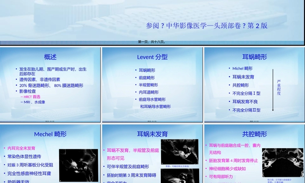 先天性内耳畸形读片2.pptx