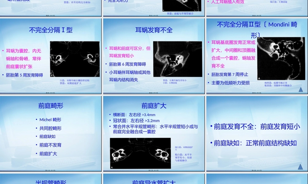 先天性内耳畸形读片2.pptx