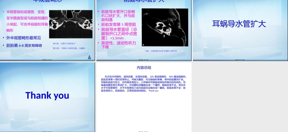先天性内耳畸形读片2.pptx