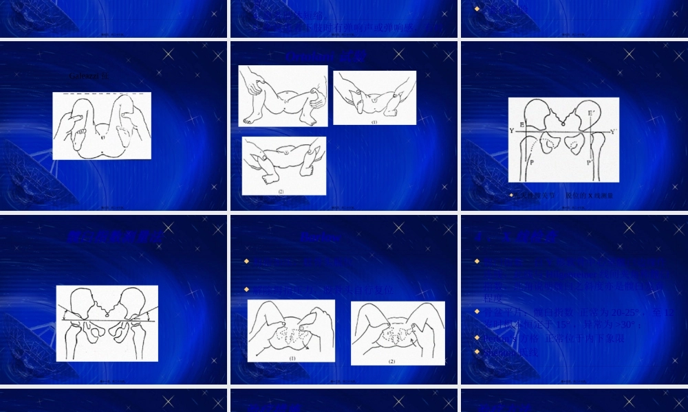 先天性髋关节脱位.pptx