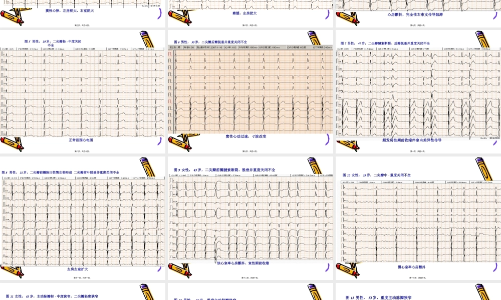 初级班第一期心脏瓣膜病的心电图表现.pptx