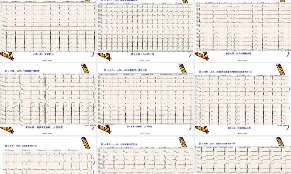 初级班第一期心脏瓣膜病的心电图表现.pptx