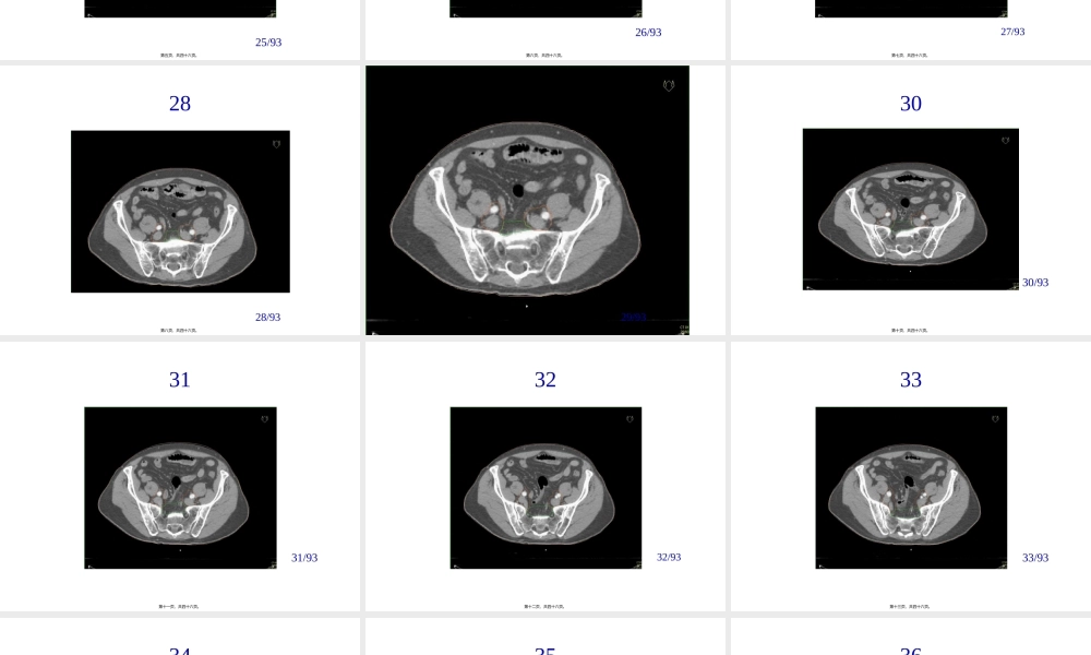 前列腺癌淋巴结及靶区勾画.pptx