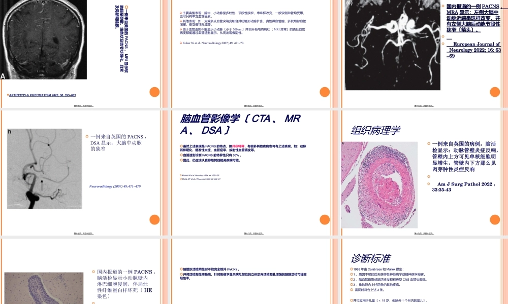 原发性中枢神经系统血管炎.ppt