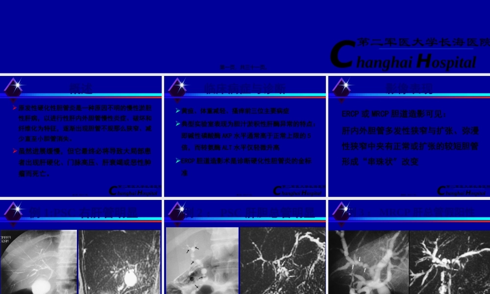 原发性硬化性胆管炎.pptx
