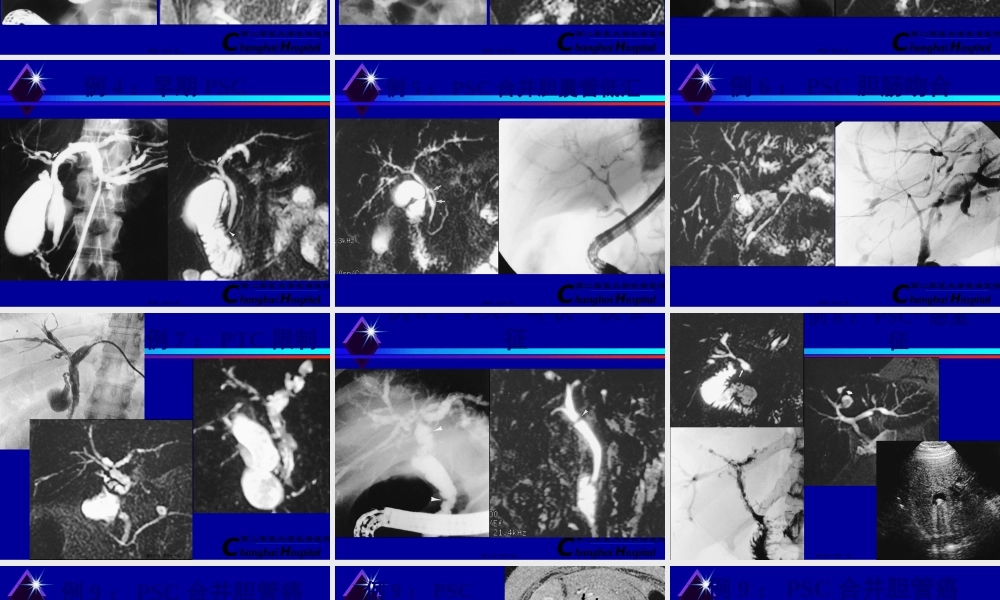 原发性硬化性胆管炎.pptx