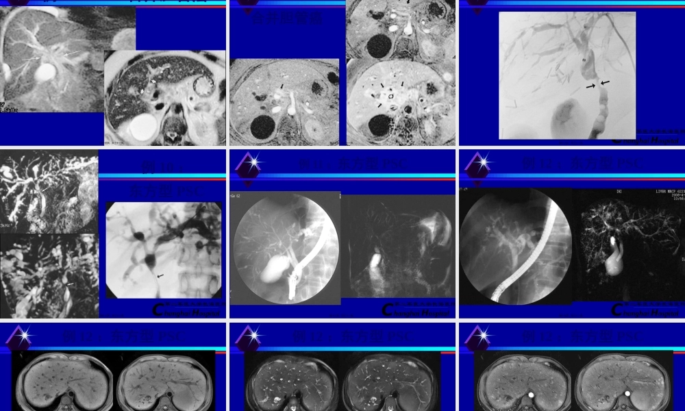 原发性硬化性胆管炎.pptx
