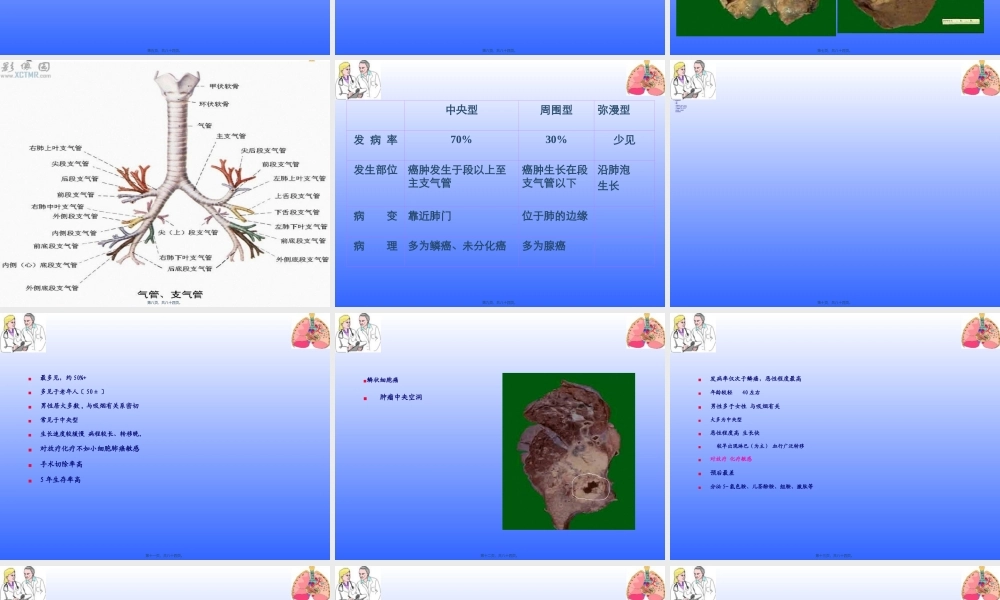 原发性支气管肺癌.ppt