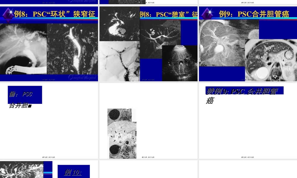 原发性硬化性胆管炎.ppt