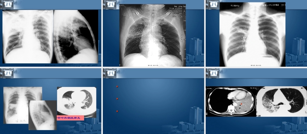 呼吸系统影像学.pptx