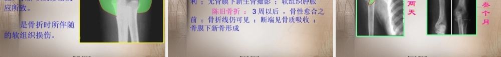 四肢骨关节损伤.ppt