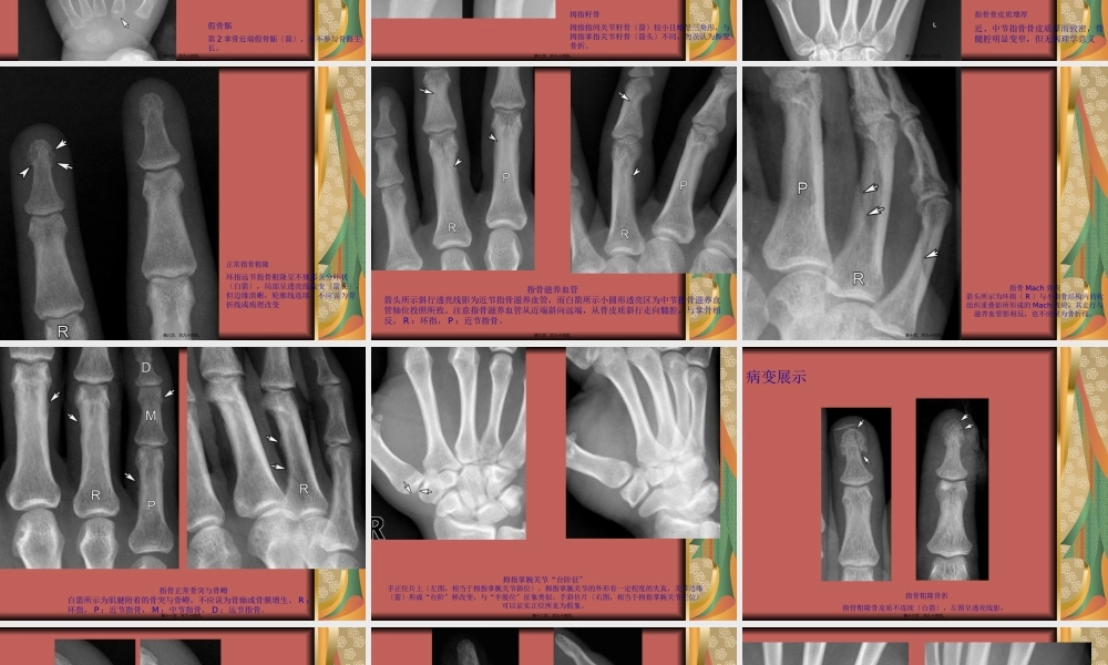 四肢关节正常变异、常见病变及创伤的影像表现.pptx