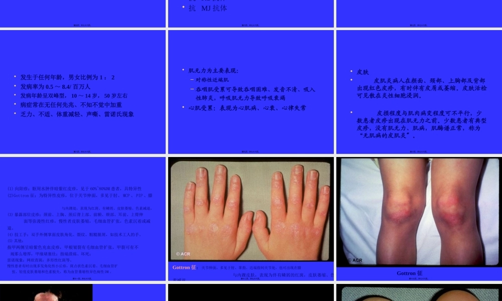 多发性肌炎&皮肌炎.pptx